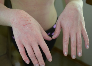 Почему трескается кожа на пальцах рук: причины и лечение 