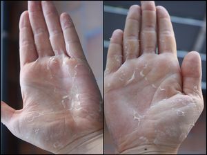 Очень сухая кожа рук с трещинами - как лечить