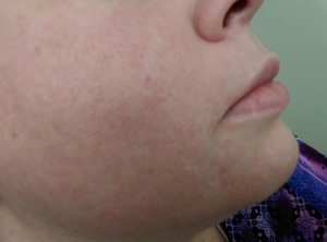 Сыпь на лице у взрослого причины и лечение в домашних условиях отзывы thumbnail