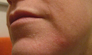 Способ от шелушения кожи лица thumbnail