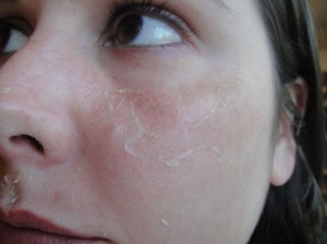 как избавиться от шелушения кожи на лице за одну ночь thumbnail