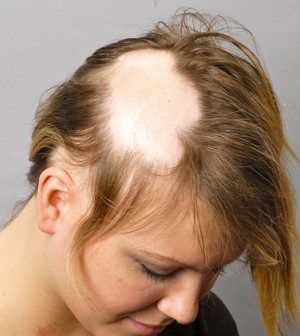 Причина выпадения волос на голове у девушки