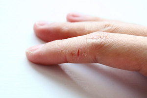Сухая кожа на костяшках пальцев рук причины thumbnail