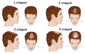 Как остановить выпадение волос у мужчины