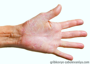 Почему трескается кожа на пальцах рук:  лечение 