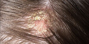 Чем лечить шелушение кожи головы